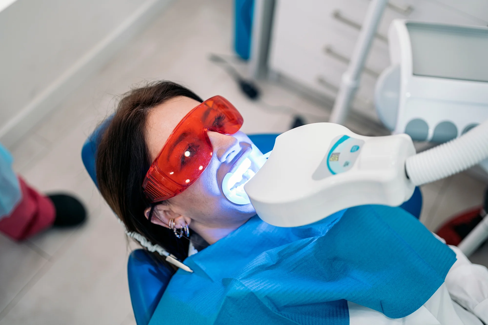 Bielenie zubov Purewhitening: kombinovaná procedúra v ambulancii aj doma – Obrázok 4