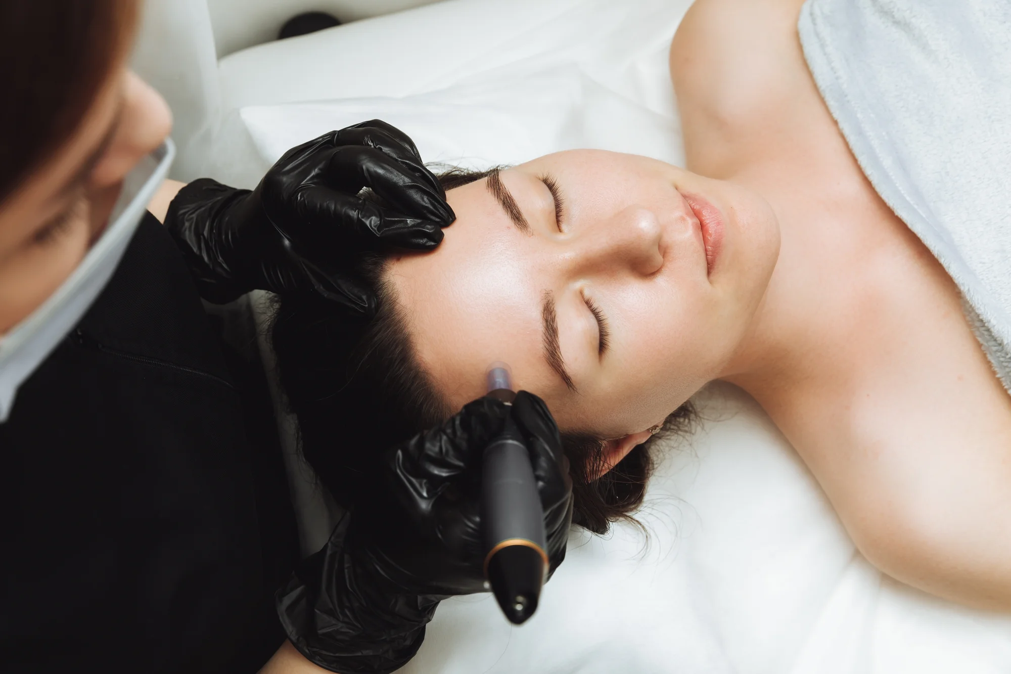 Kozmetické ošetrenia: dermaplaning pre hladkú a sviežu pleť a mezoterapia – Obrázok 4