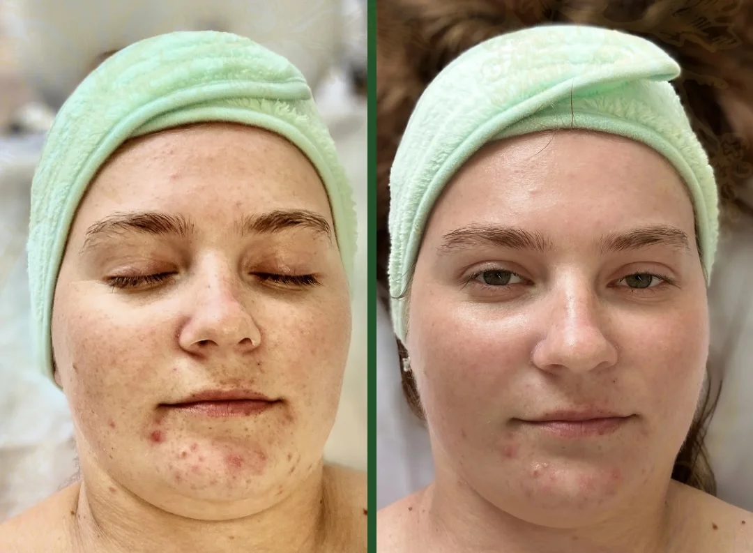 Kozmetické ošetrenie pleti luxusnou kozmetikou Larens alebo relaxačný balíček – Obrázok 6