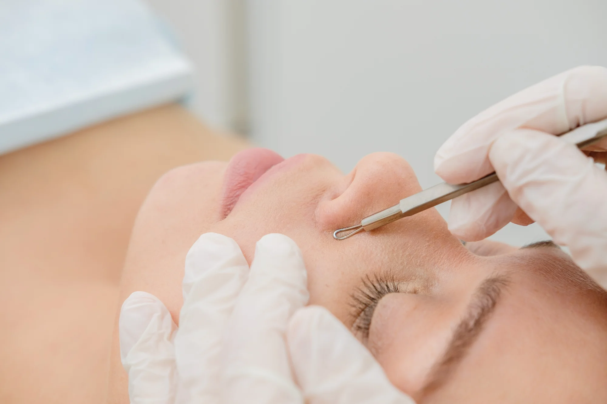 Hĺbkové čistenie, vodná dermabrázia, lifting pleti pomocou rádiofrekvencie alebo rádiomezolift – Obrázok 4