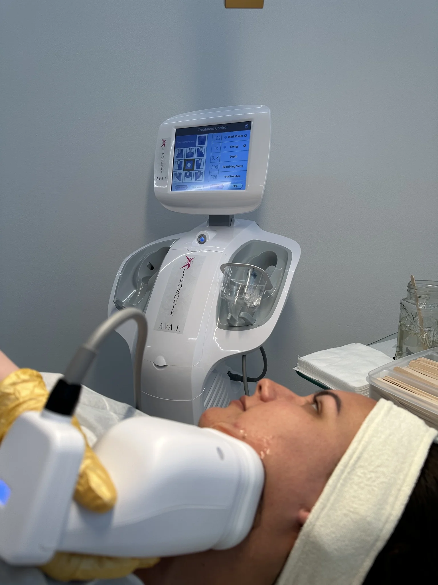 Neinvazívna liposukcia ultrazvukom Liposonix AVA .I. – Obrázok 4