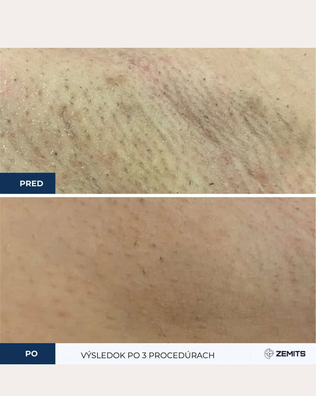 Laserové epilácia rôznych partií: Zbavte sa chĺpkov navždy – Obrázok 6