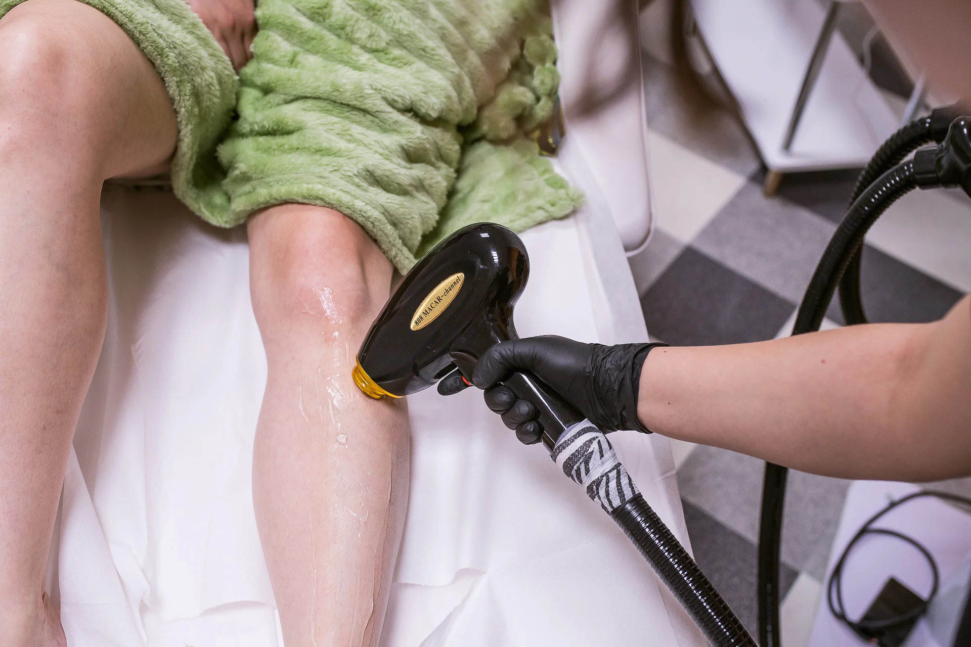 Odstránenie ochlpenia pomocou vysoko výkonného diódového lasera – Obrázok 4