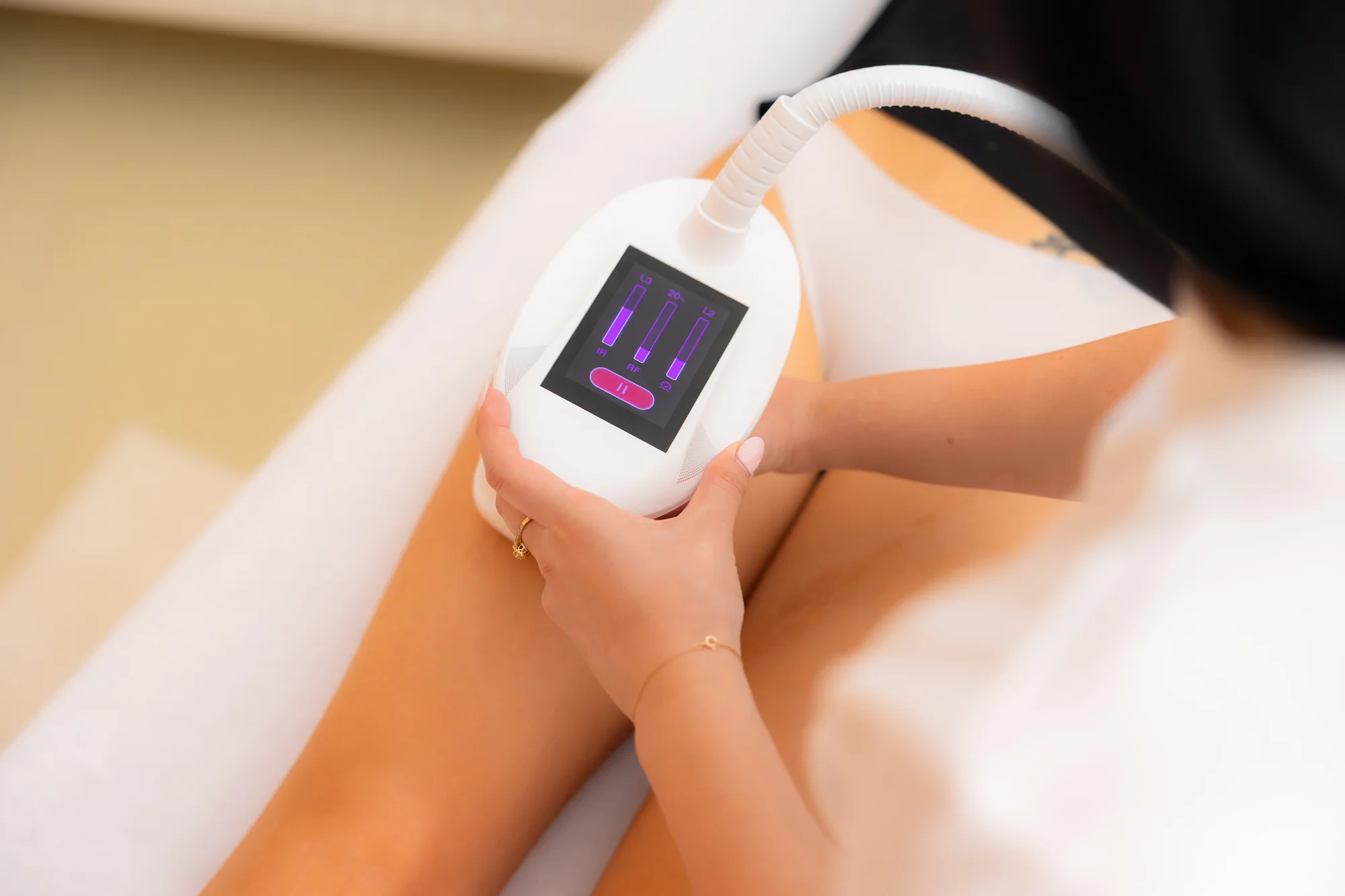 Ošetrenie VelaShape pre redukciu celulitídy a spevnenie pokožky – Obrázok 3