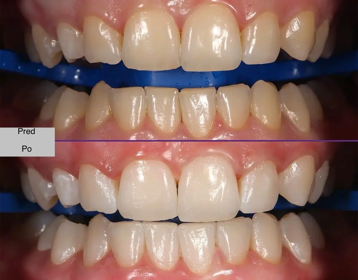 Dentálna hygiena alebo bielenie zubov technológiou Magic Light Pro Plus – Obrázok 5