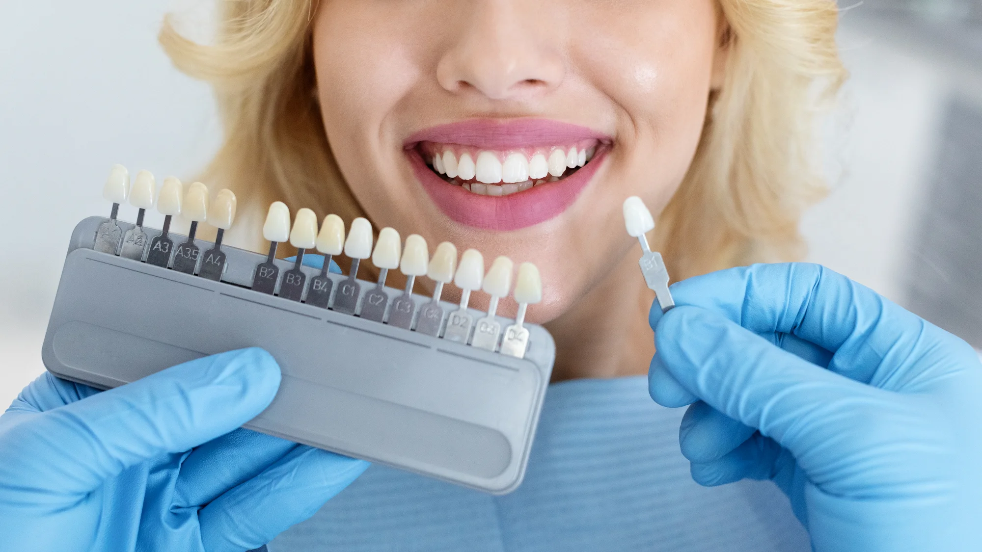 Dentálna hygiena podľa švajčiarskeho protokolu alebo bielenie zubov Opalescence Boost – Obrázok 3