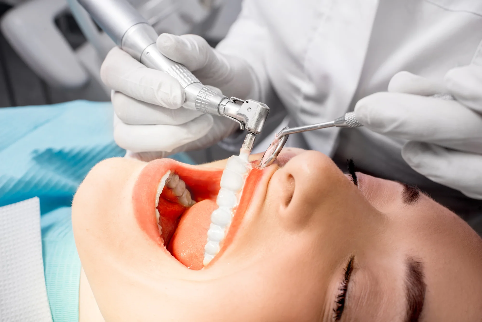 Dentálna hygiena podľa švajčiarskeho protokolu alebo bielenie zubov Opalescence Boost – Obrázok 5