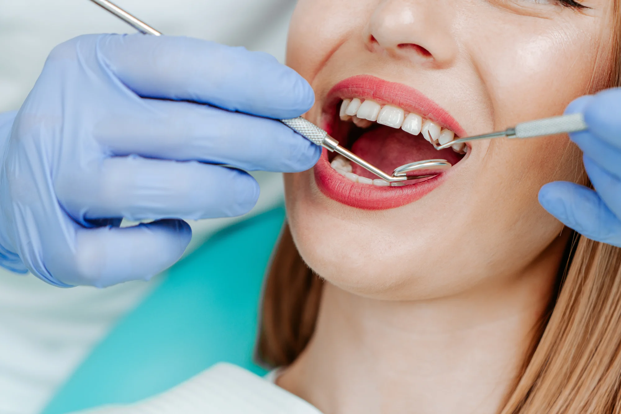 Dentálna hygiena s pieskovaním alebo bielenie zubov – Obrázok 2