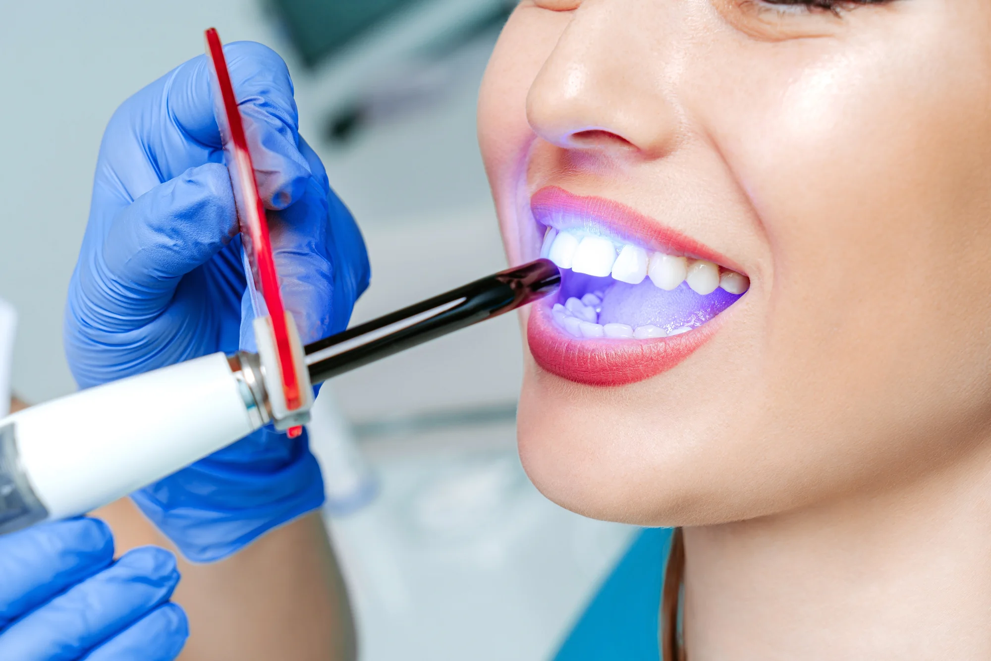 Dentálna hygiena s pieskovaním alebo bielenie zubov – Obrázok 4