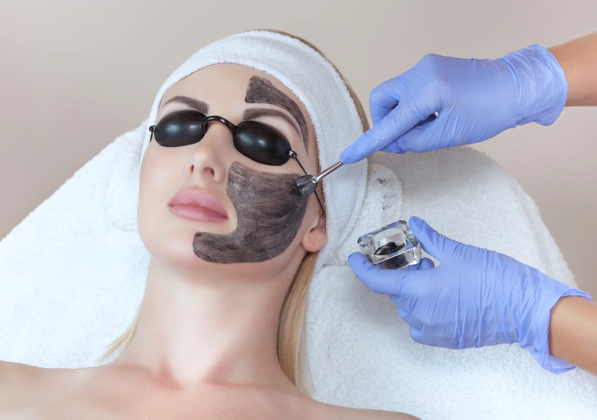 Microneedling alebo Carbon Laser Peel pre zjednotenú pleť bez akné – Obrázok 6