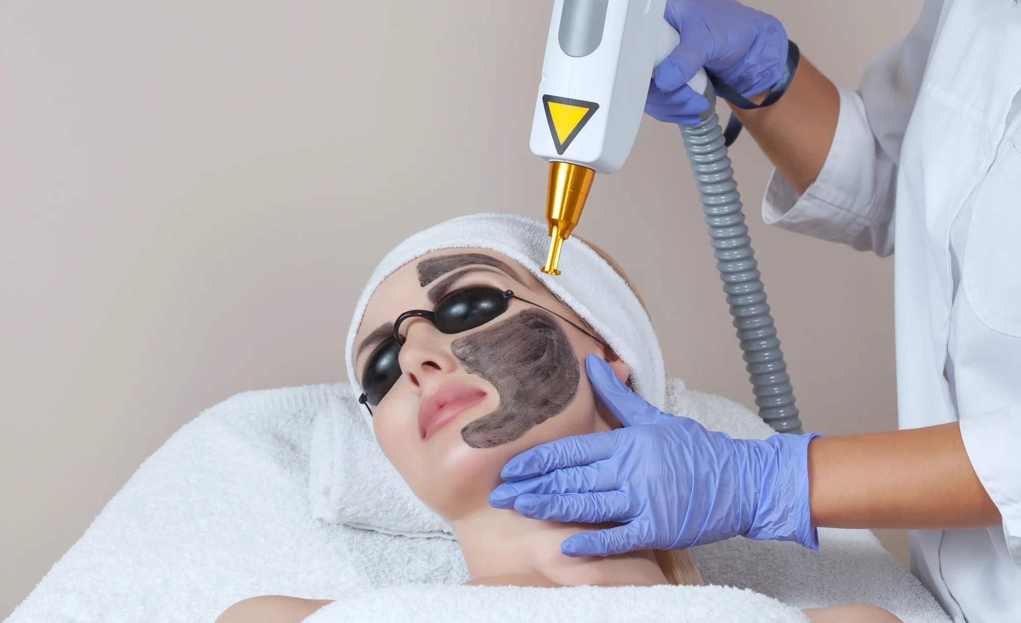 Microneedling alebo Carbon Laser Peel pre zjednotenú pleť bez akné – Obrázok 2