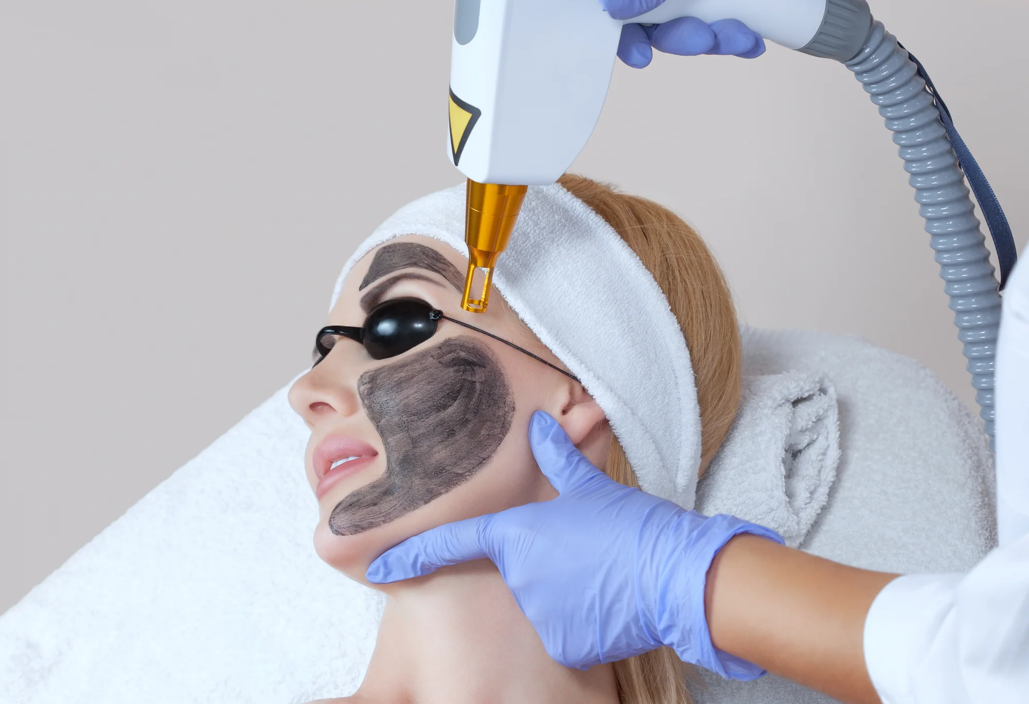 Microneedling alebo Carbon Laser Peel pre zjednotenú pleť bez akné – Obrázok 3