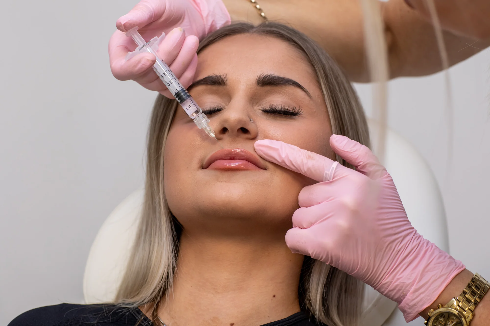 Výplň alebo hydratácia pier kyselinou hyalurónovou v Neuroderm – Obrázok 5