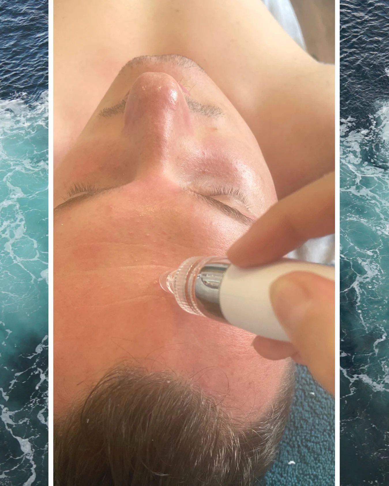 Zamatová pleť: čistenie, dermabrázia, rádiofrekvencia alebo hydratačná kúra – Obrázok 5