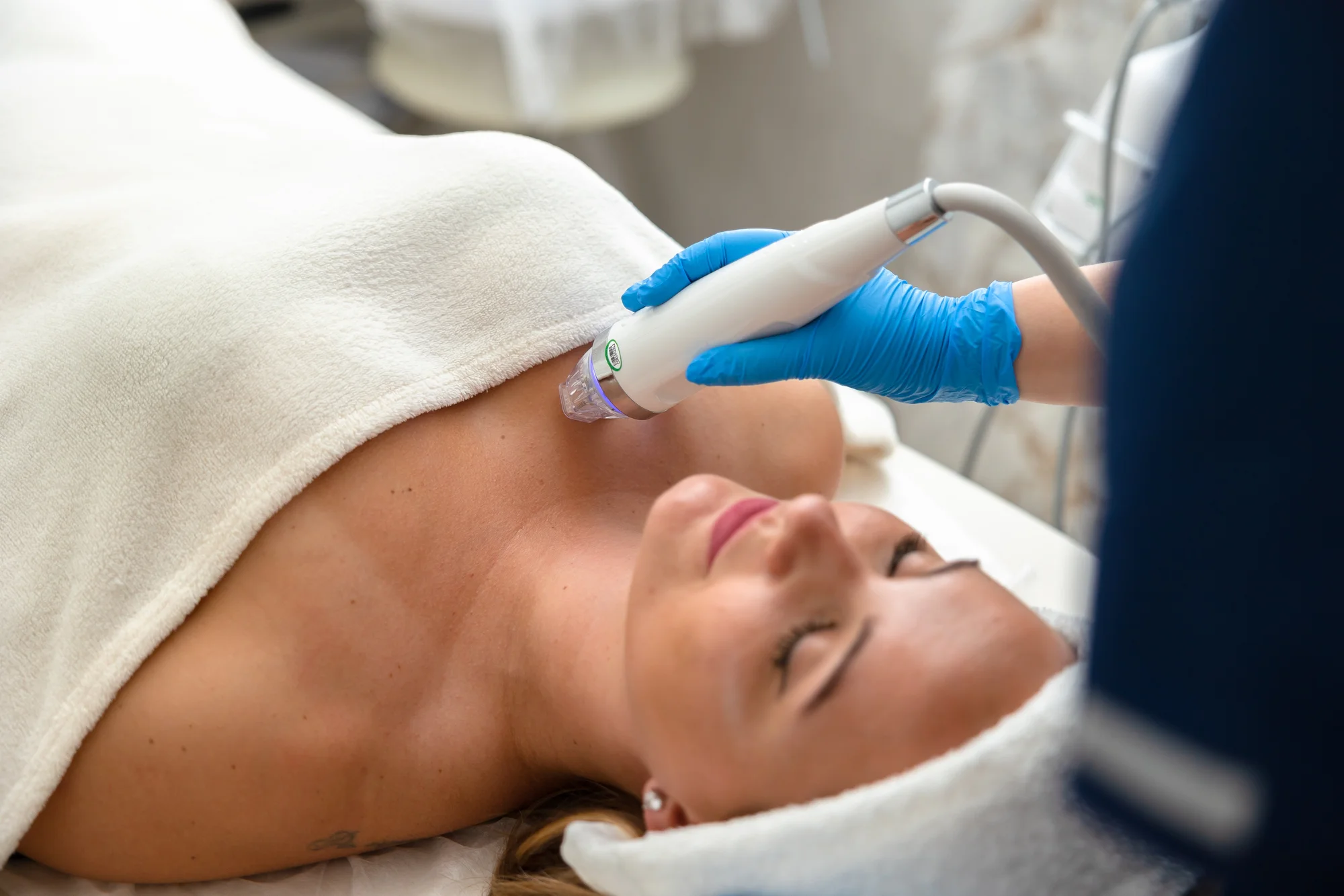 Medicínska mikroihličková frakčná rádiofrekvencia v salóne Krása štúdio – Obrázok 6