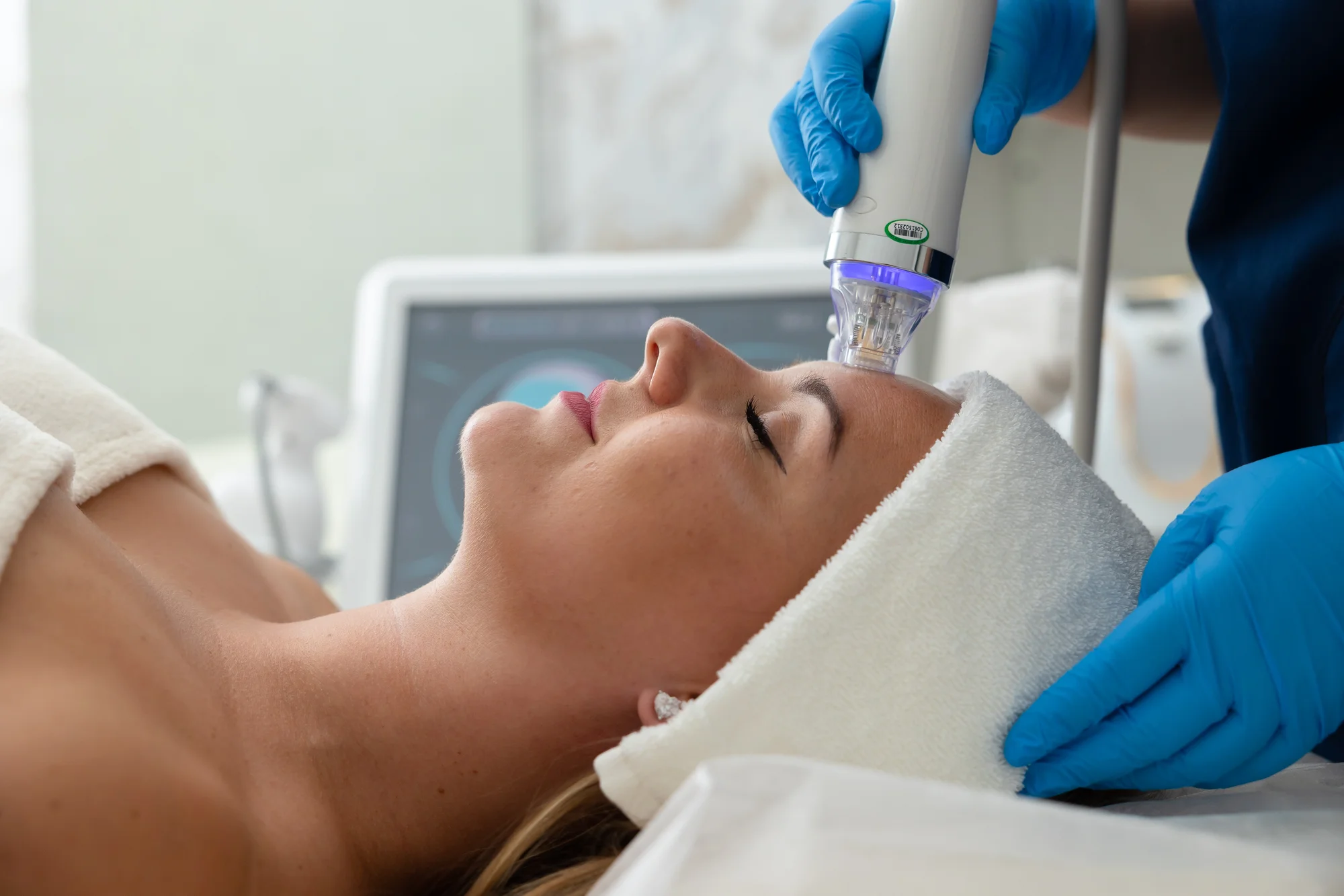 Medicínska mikroihličková frakčná rádiofrekvencia v salóne Krása štúdio – Obrázok 4