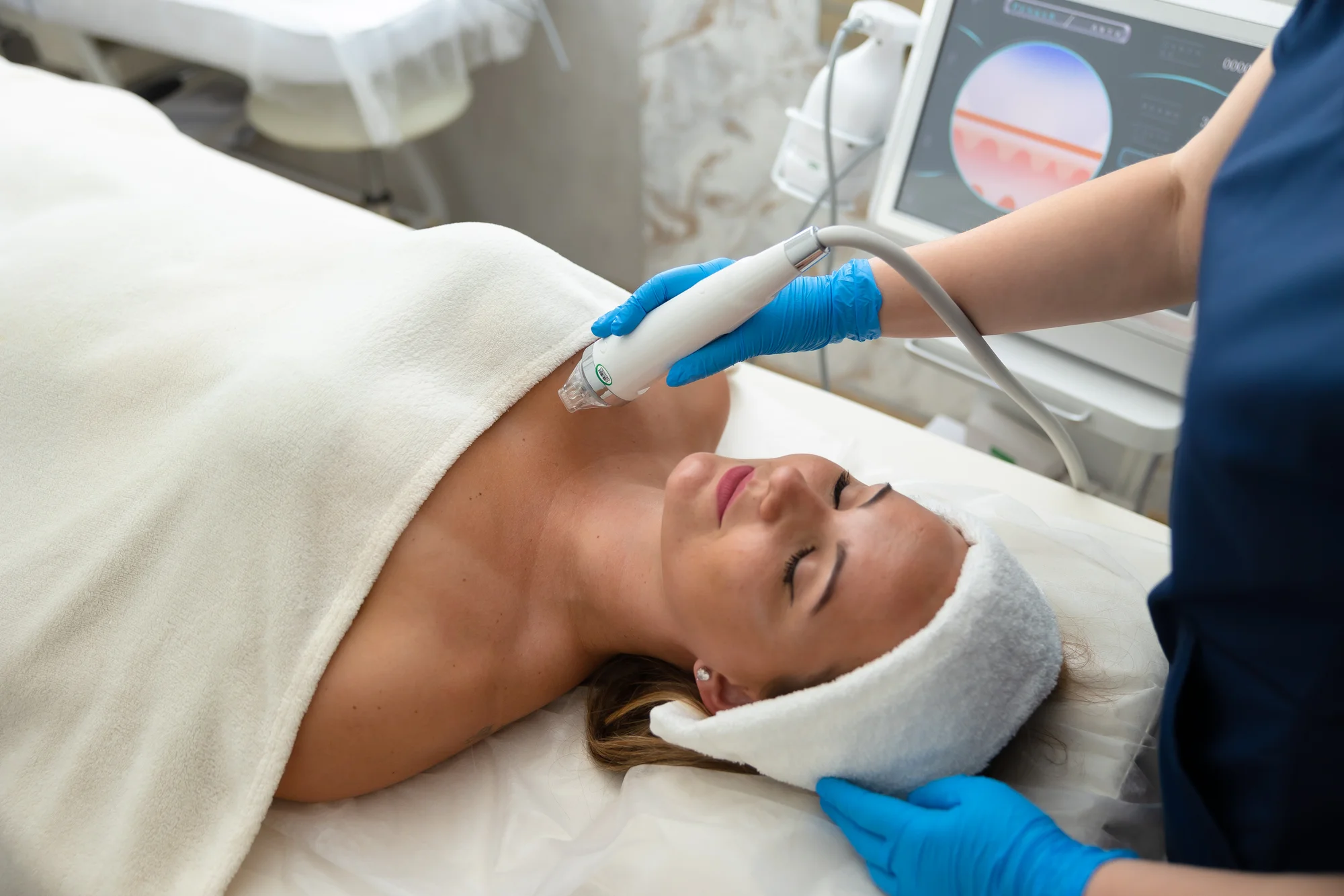 Medicínska mikroihličková frakčná rádiofrekvencia v salóne Krása štúdio – Obrázok 2