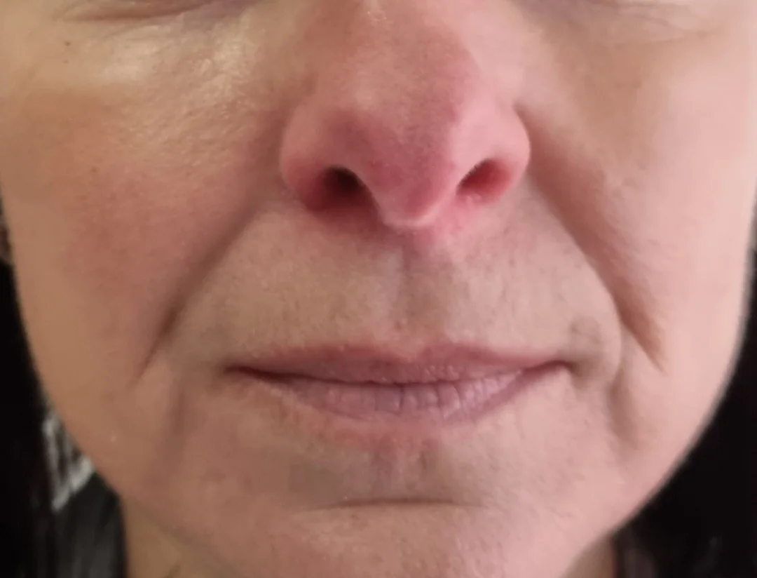 Horný, dolný a celkový facelifting HIFU – Obrázok 5