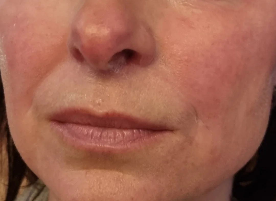Horný, dolný a celkový facelifting HIFU – Obrázok 6