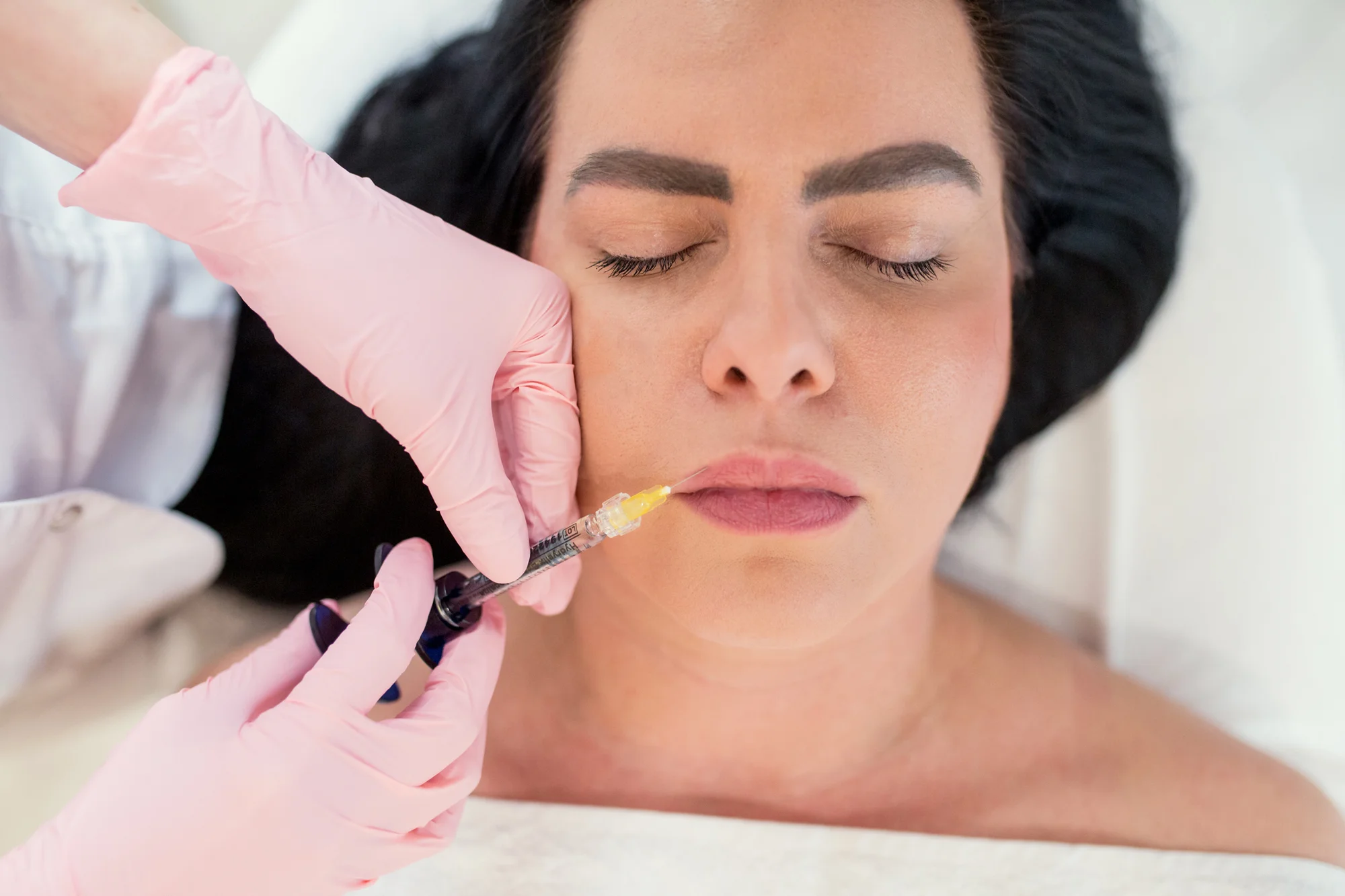 Kyselina hyalurónová: Zväčšenie pier, výplň vrások, tekutý lifting či rhinoplastika – Obrázok 3