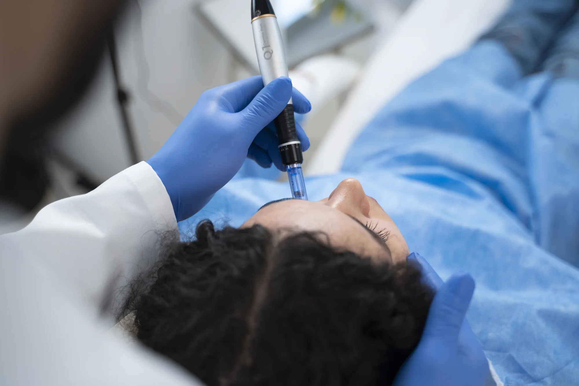 Microneedling alebo Carbon Laser Peel pre zjednotenú pleť bez akné – Obrázok 5