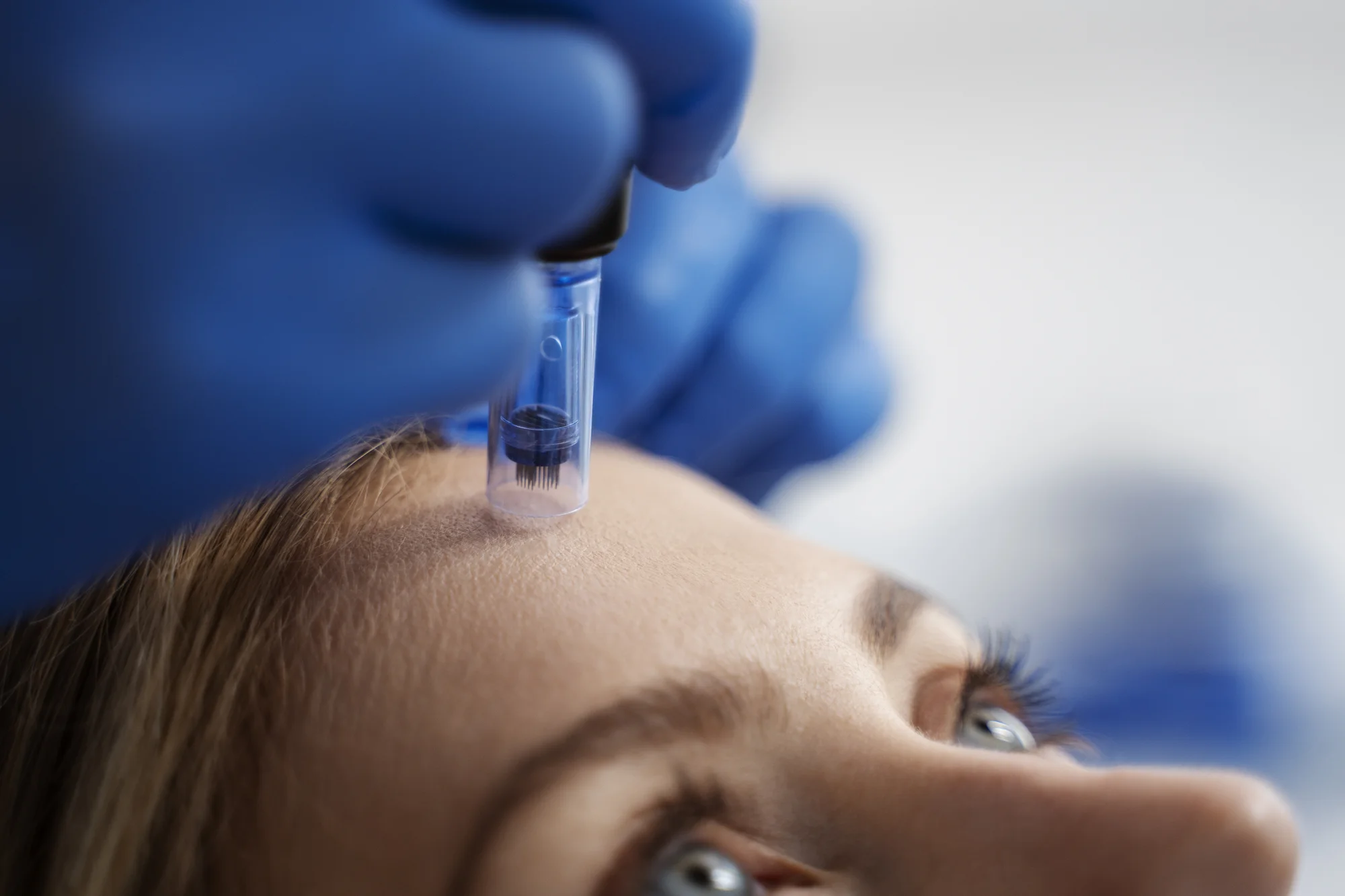 Microneedling alebo Carbon Laser Peel pre zjednotenú pleť bez akné – Obrázok 4