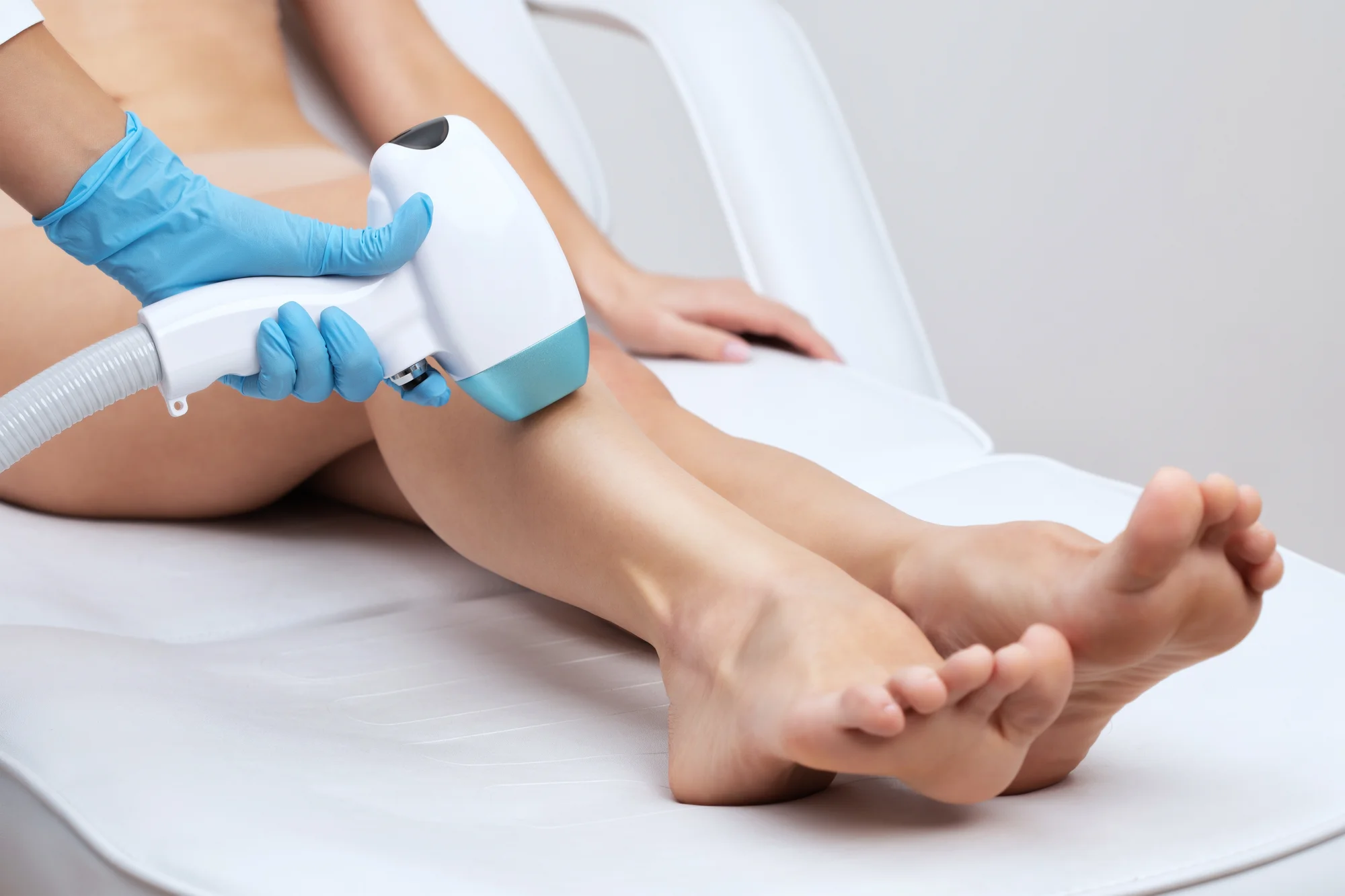 Trvalá epilácia medicínskym laserom Candela GentleLase PRO – Obrázok 6