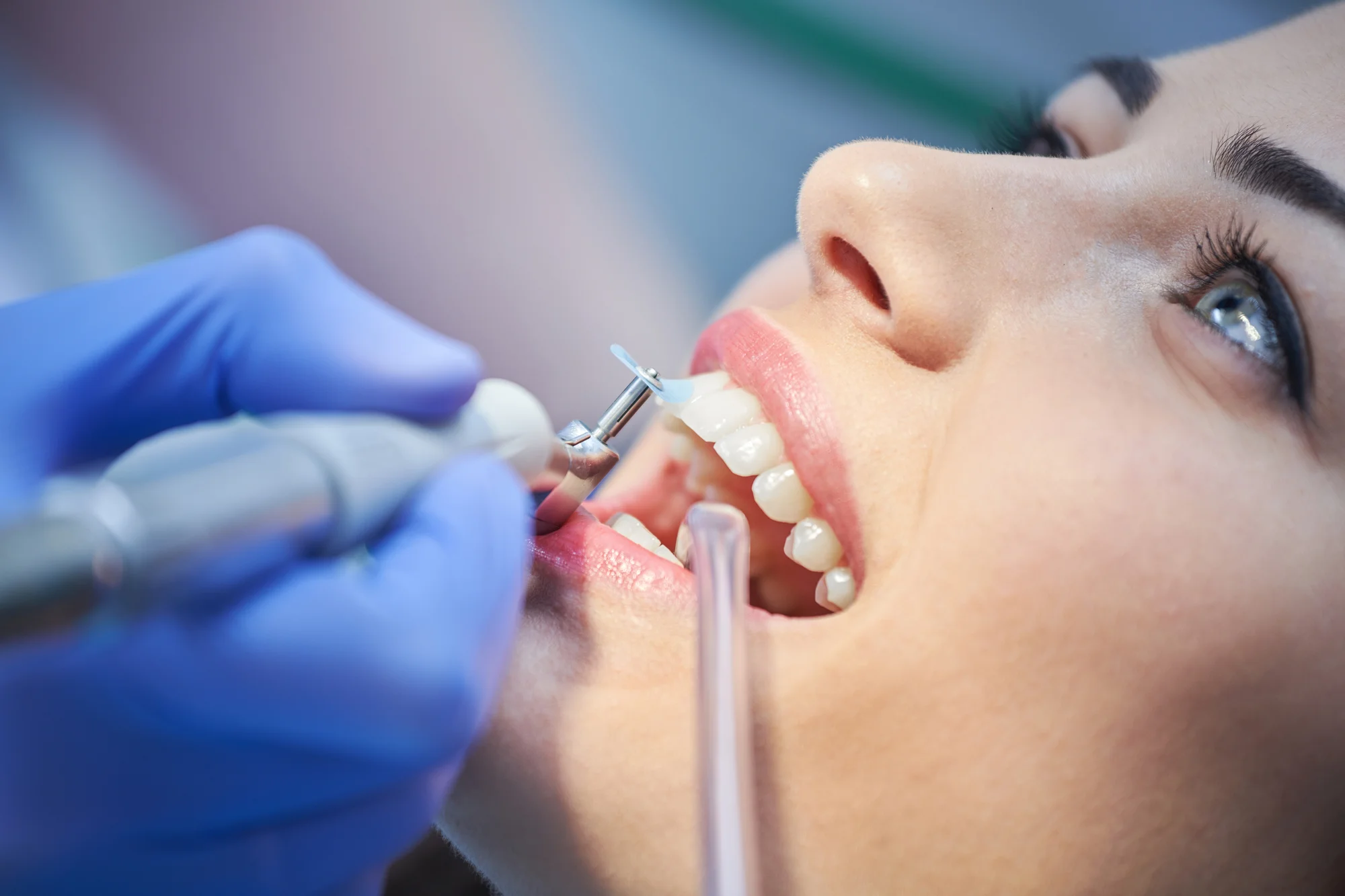 Profesionálna starostlivosť o váš úsmev: Dentálna hygiena alebo bielenie zubov – Obrázok 2