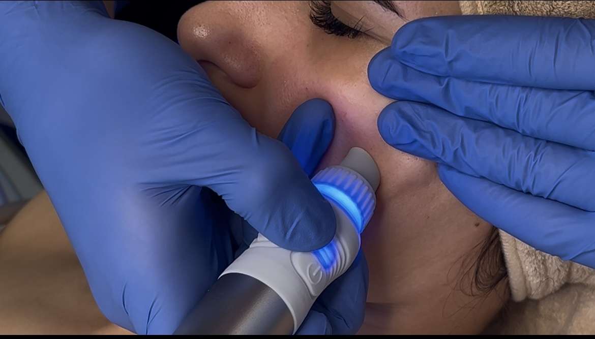 Ošetrenie Hydrafacial pre žiarivú pleť v Maya Beauty Clinic – Obrázok 4