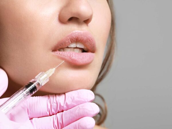 Výplň pier technikou Russian lips alebo odstránenie vrások kys. hyalurónovou