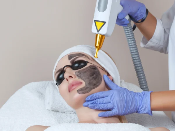 Microneedling alebo Carbon Laser Peel pre zjednotenú pleť bez akné
