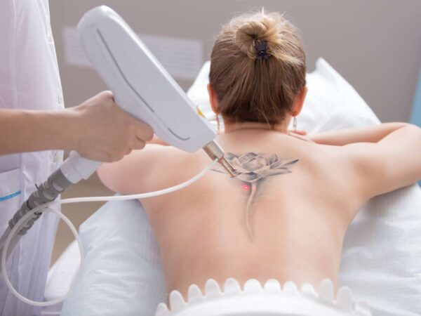 Laserové odstránenie tetovanie alebo PMU v Maya Beauty Clinic