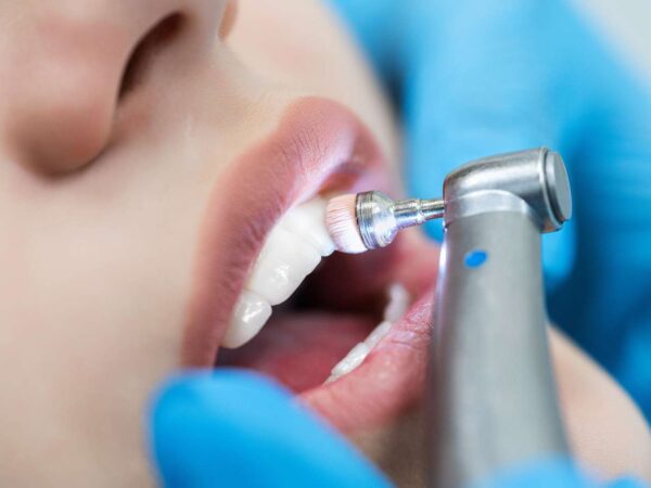 Profesionálna dentálna hygiena, bielenie zubov a ozónoterapia v 24 DENTAL – zubná pohotovosť III.veže