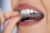 22% zľava na neviditeľný zubný strojček Full/Comprehensive + Dental Monitoring